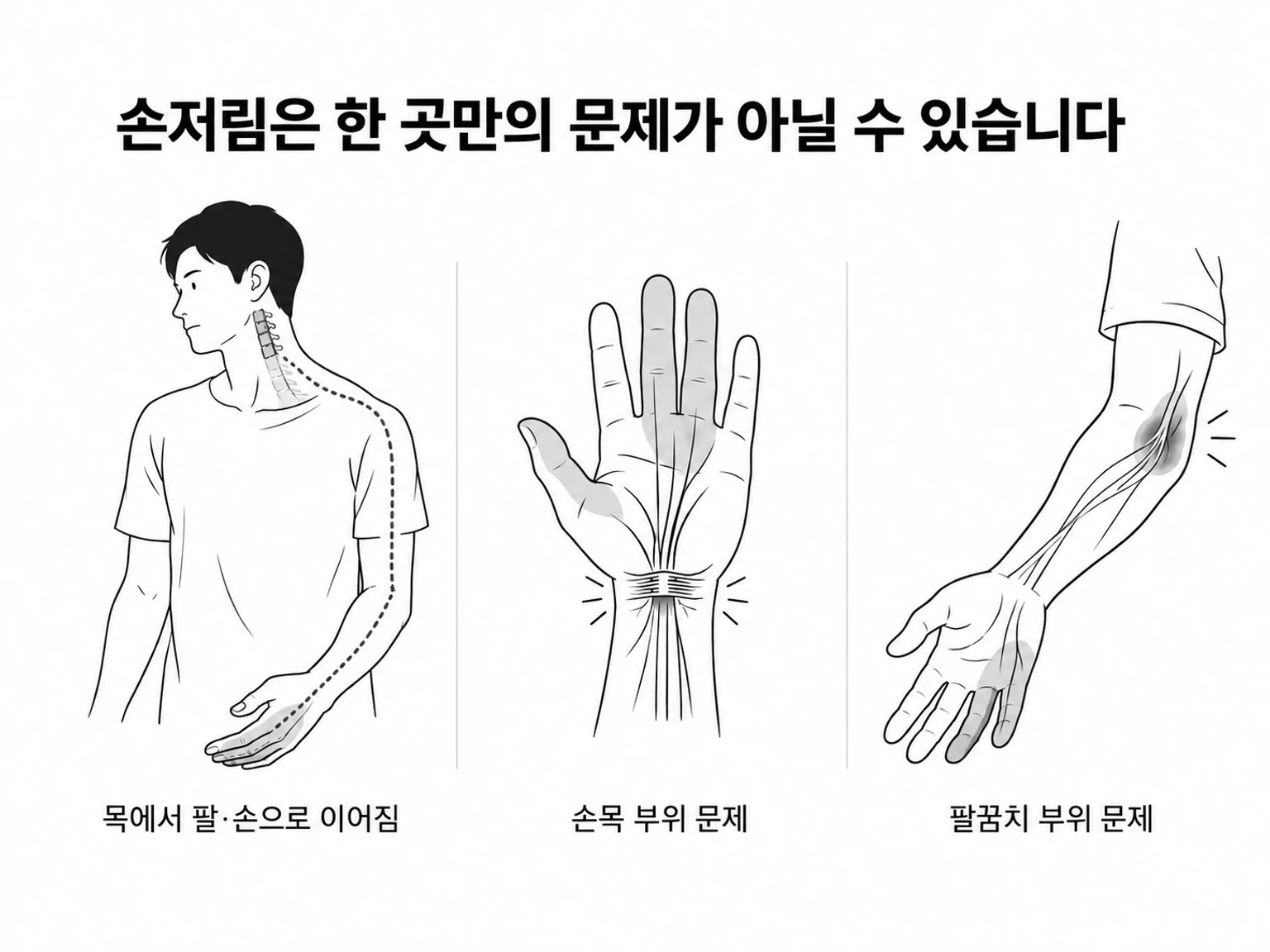 손저림은 한 곳만의 문제가 아닐 수 있습니다. 목에서 팔·손으로 이어지는 증상, 손목 부위 문제, 팔꿈치 부위 문제를 보여주는 승인된 흑백 선화